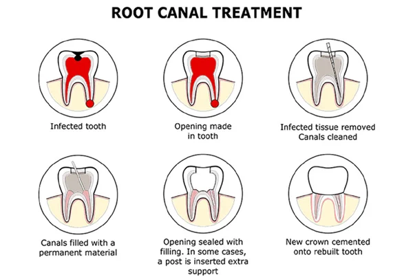 Root Canal Treatment (RCT)