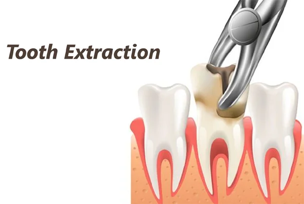 Painless Tooth Extraction