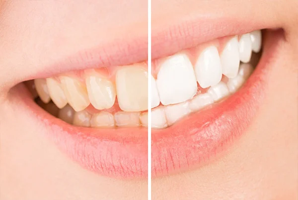 Pyorrhea & Bleeding Gums
