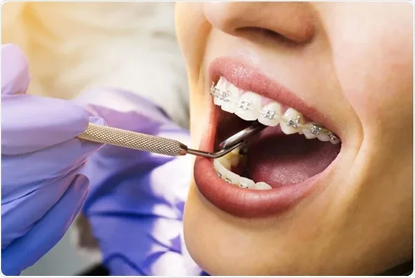 Braces